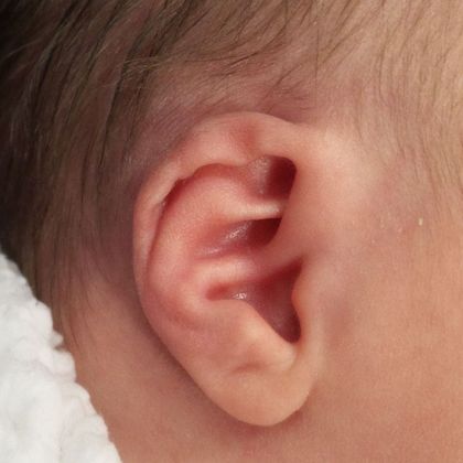 Bent ear cartilage