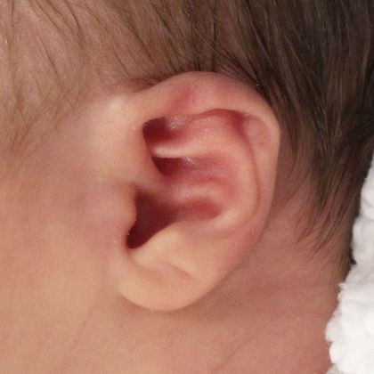 ear lidding deformity