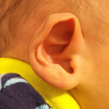 Large prominent ear