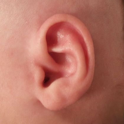 Helical rim ear deformity after treatment