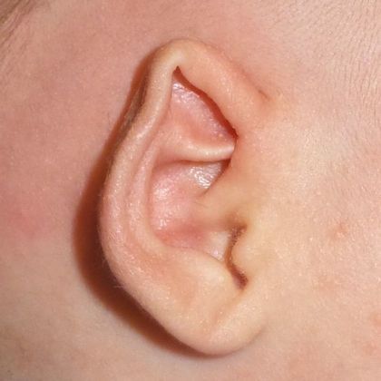 helical rim ear deformity