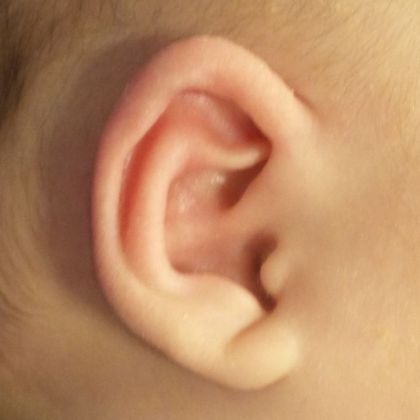 helical rim ear deformity fixed.