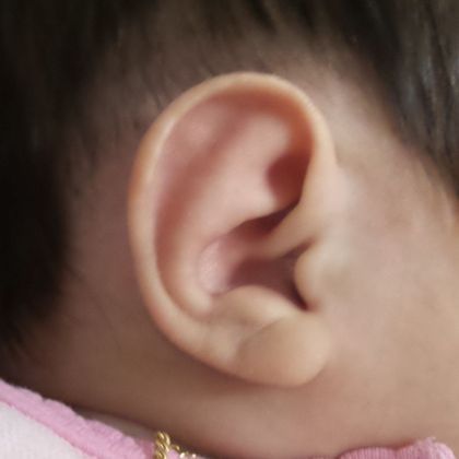 Helical rim ear deformity fixed