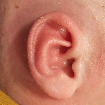 pointed ear cartilage after treatment