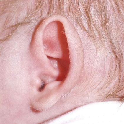 prominent large ear