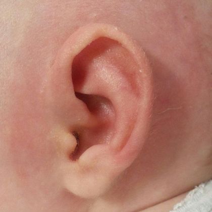 prominent large ear after treatment