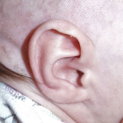 a Stahl’s ear deformity after treatment