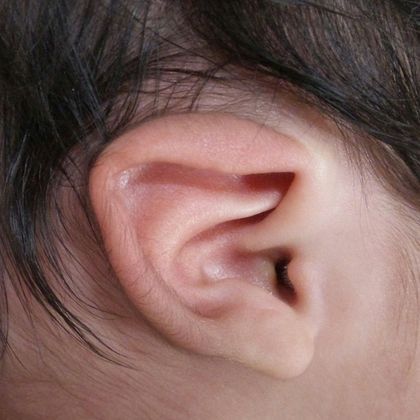 lidding deformity of the ear with the cartilage folded over