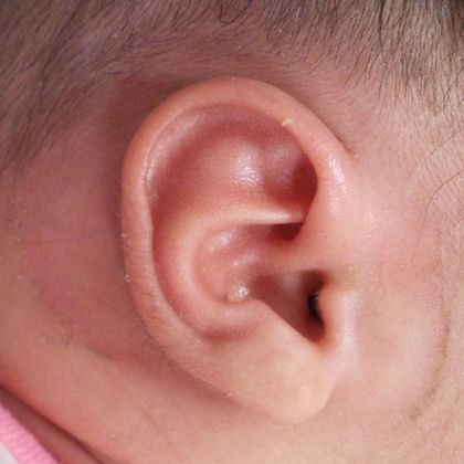lidding deformity where the top ear cartilage after treatment