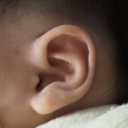 lidding deformity of the ear with the cartilage folded over after treatment