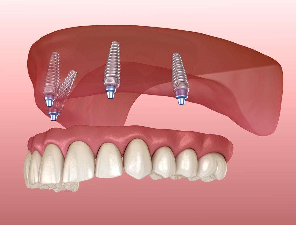 Maxillary Prosthesis With Gum