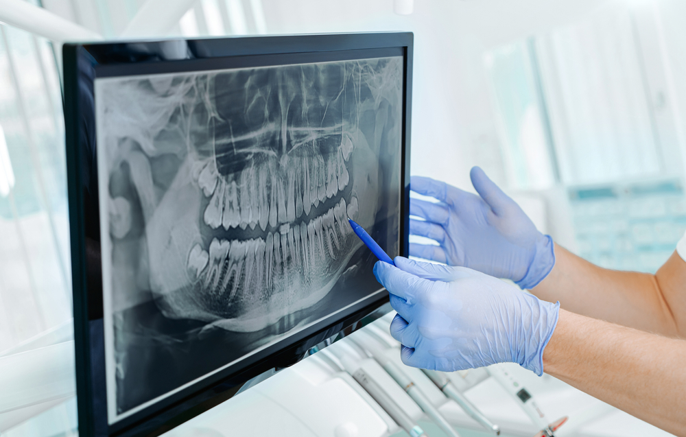 The Role of Digital X-Rays in Modern Dental Diagnosis