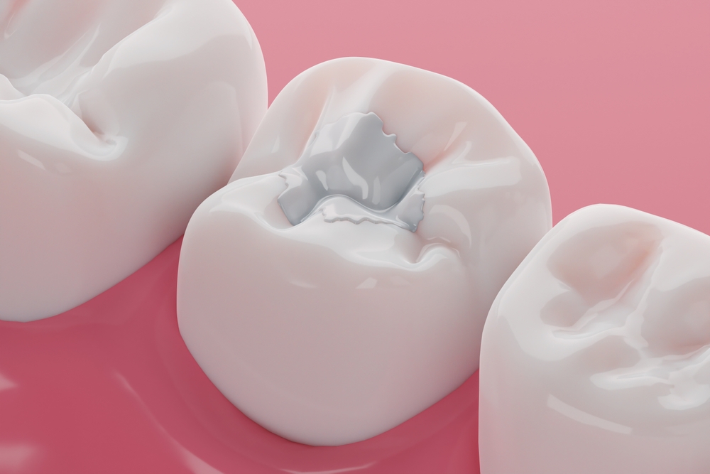 Tooth-Colored Fillings Why They’re the New Standard