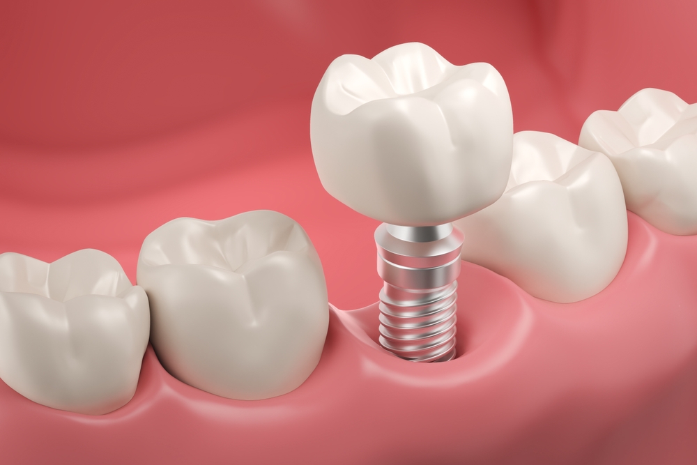 Closeup white tooth and gum with Dental implant
