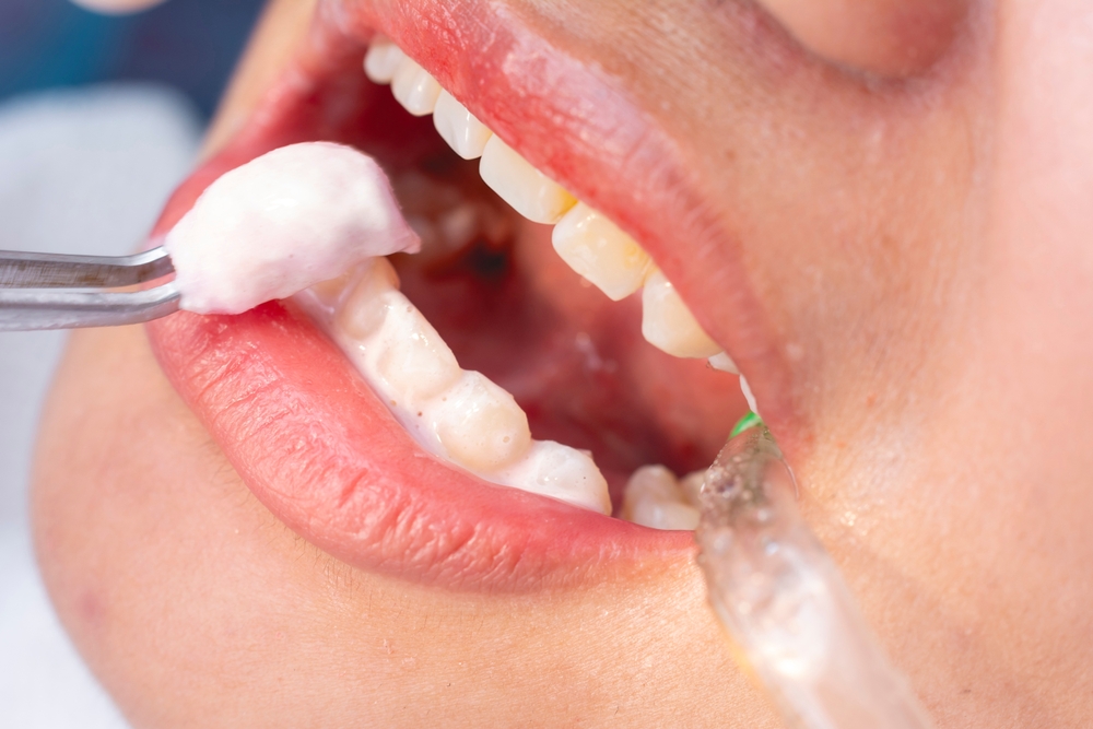 A dental professional using tweezers to apply a medicated paste or fluoride gel onto the patient’s teeth