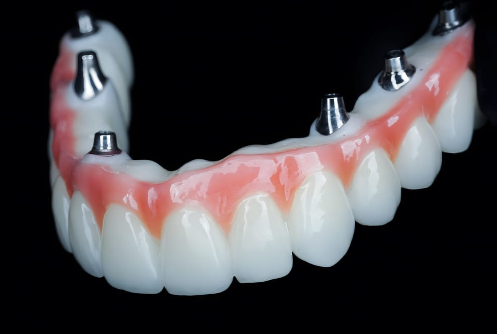 Full-arch dental prosthesis with dental implant support in dental surgery