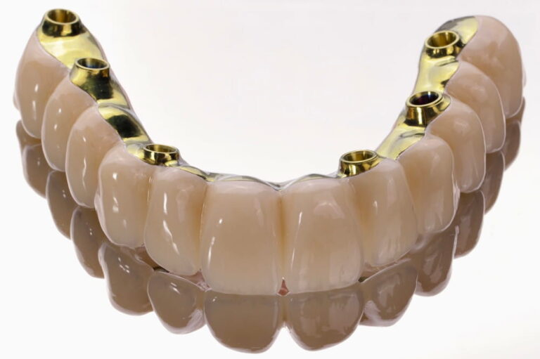 FP1, All on X, Zirconia bridge, All-on-6, Dental implants