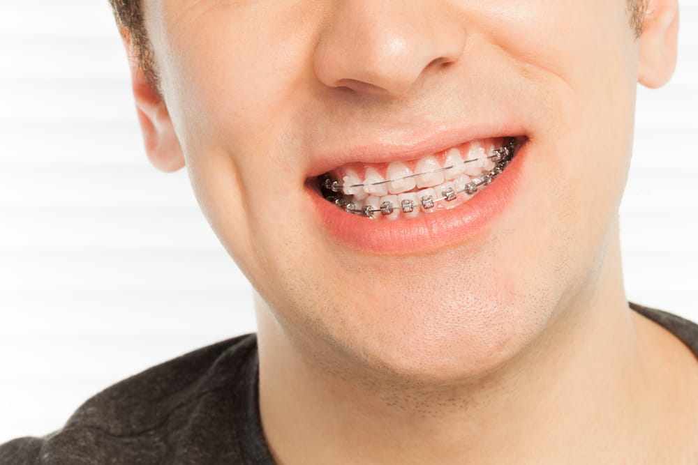 Happy man's smile with orthodontic cases