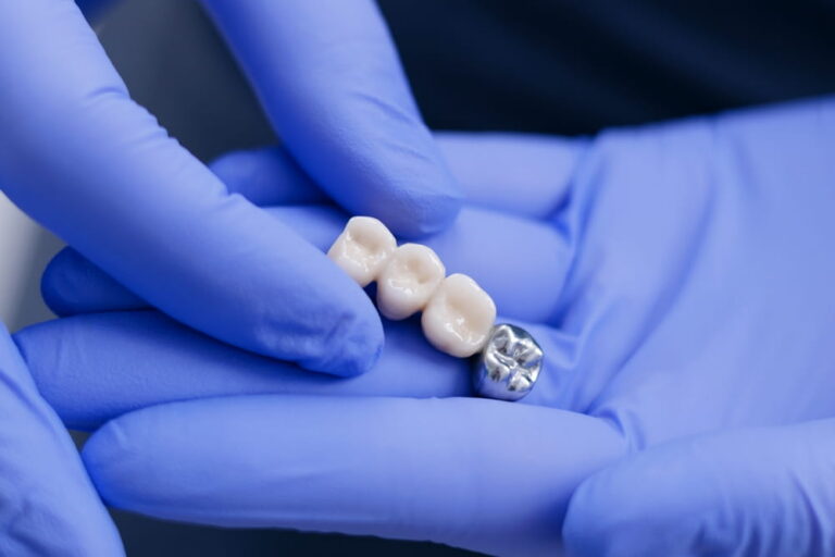 Dentist holding dental bridge crowns prosthesis and clinching model in blue gloves.