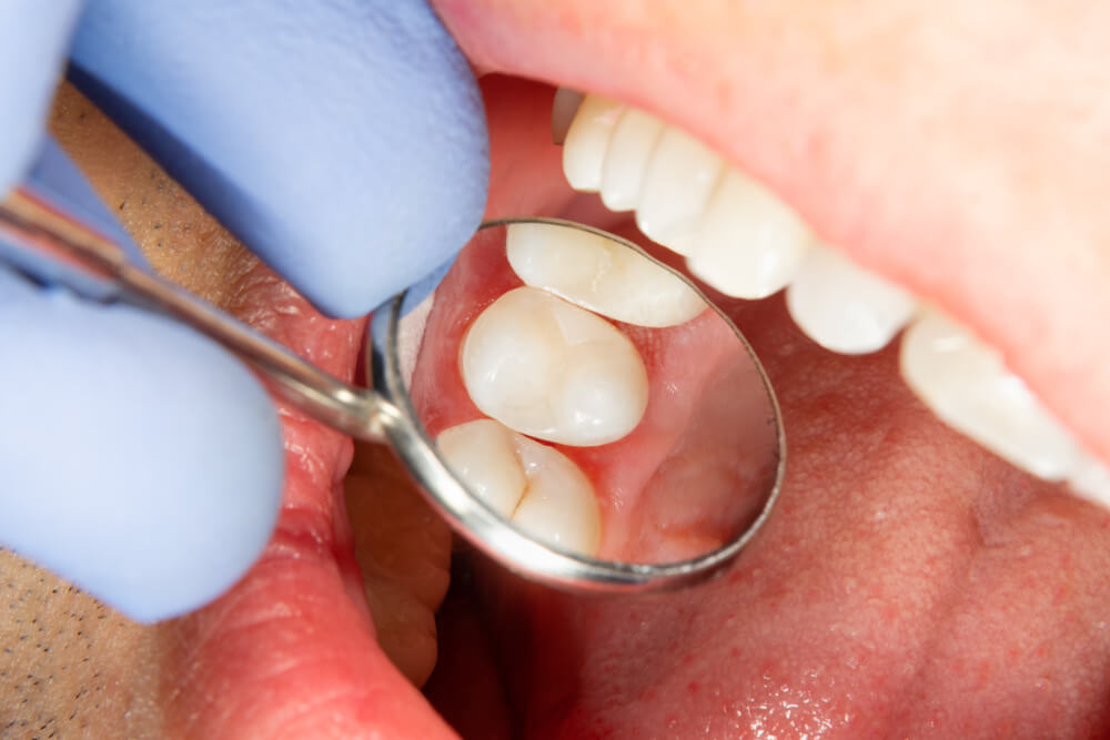 two chewing side teeth of the upper jaw after treatment of caries