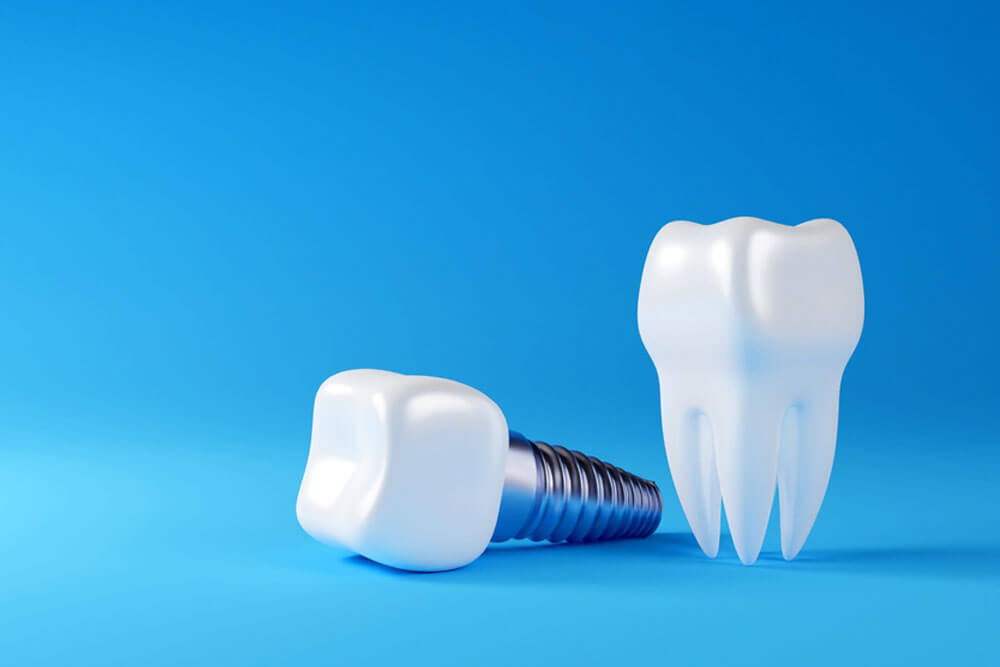 dental implant and dental inspection teeth