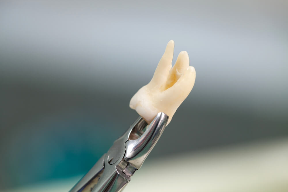 Dental equipment holding an extracted tooth