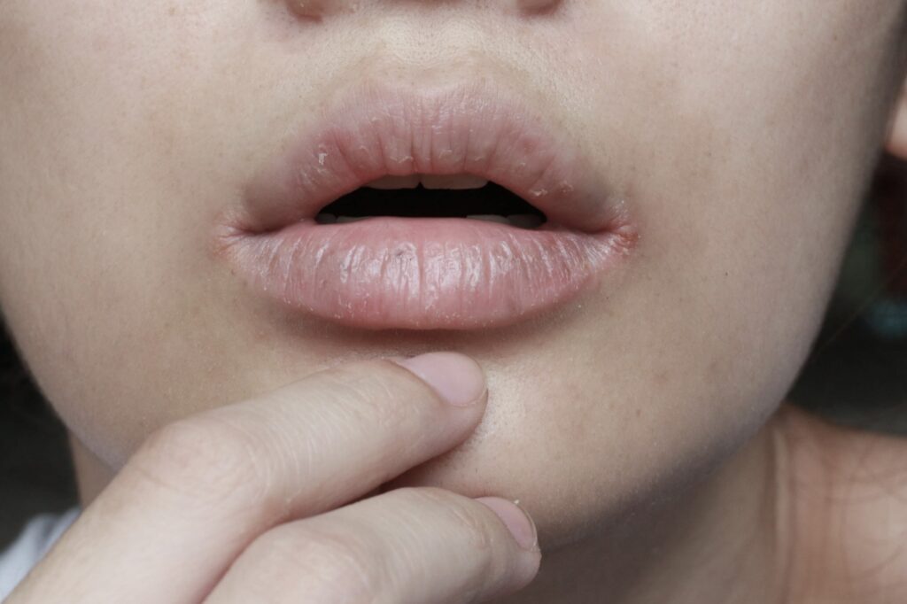 chapped, cracked lips caused wound on the corner of the lips