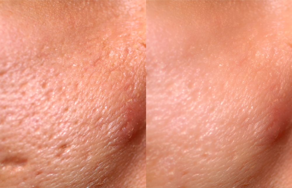 A before and after of Skin Resurfacing