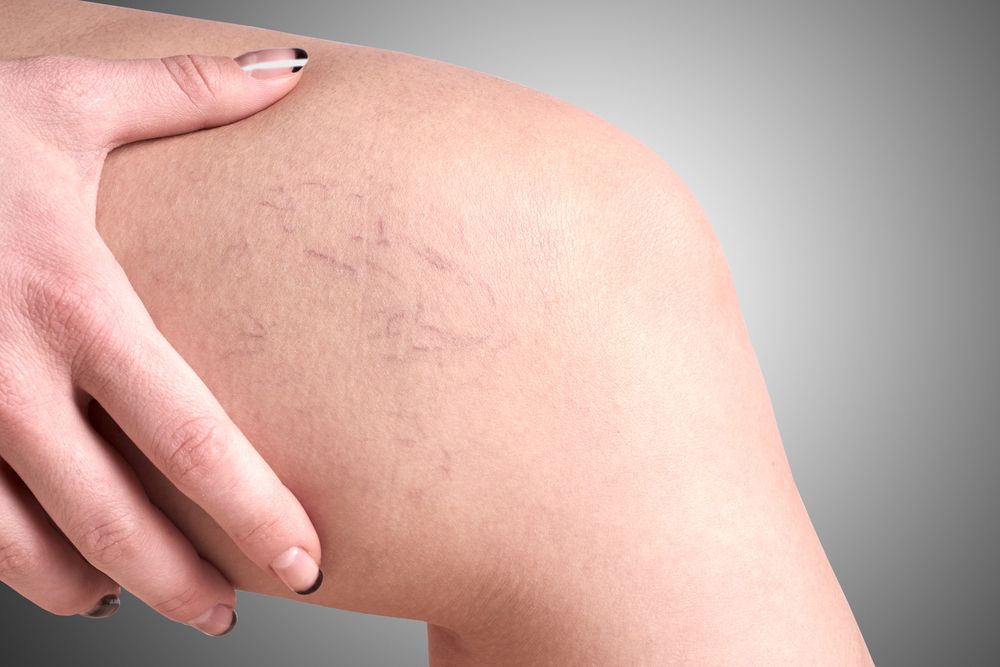 Say Goodbye To Spider Veins With Laser Vein Treatment