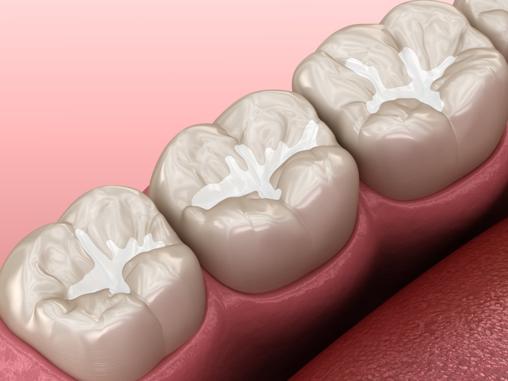 Molar Fissure dental fillings