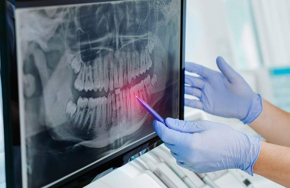 Hands doctor dentist in gloves show the teeth on x-ray on digital screen