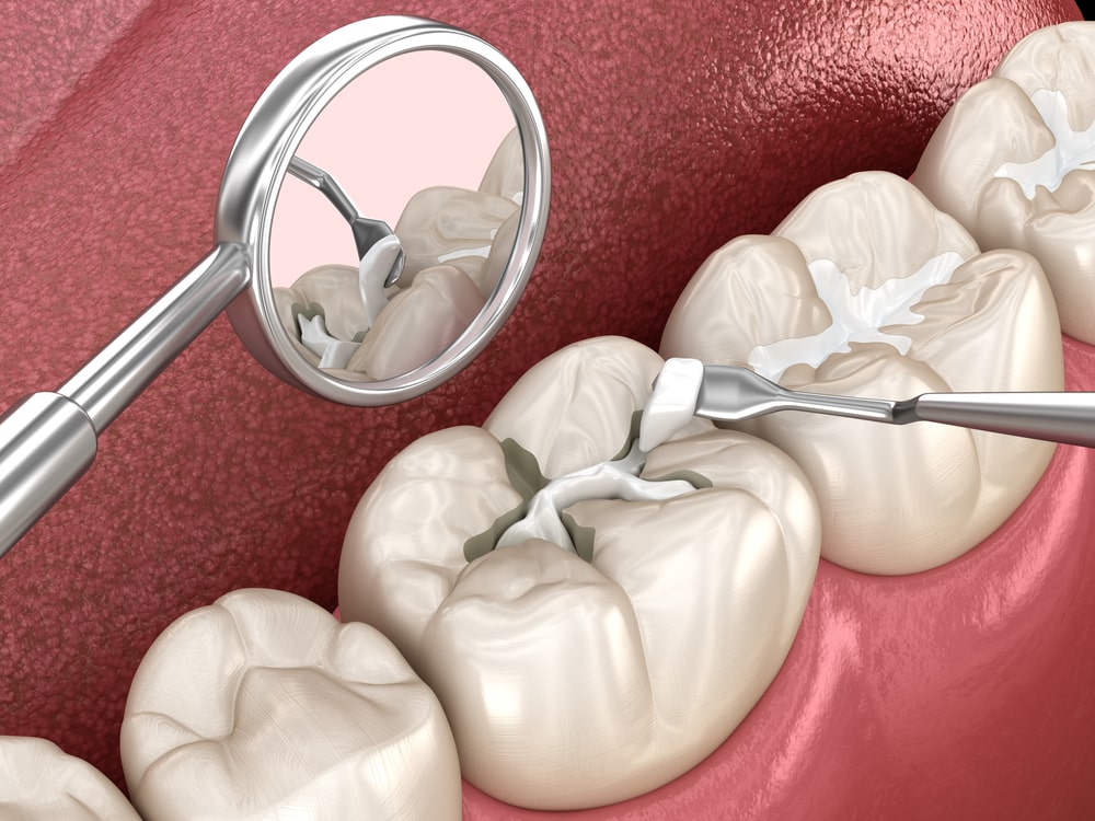 Molar tooth fissure restoration with filling