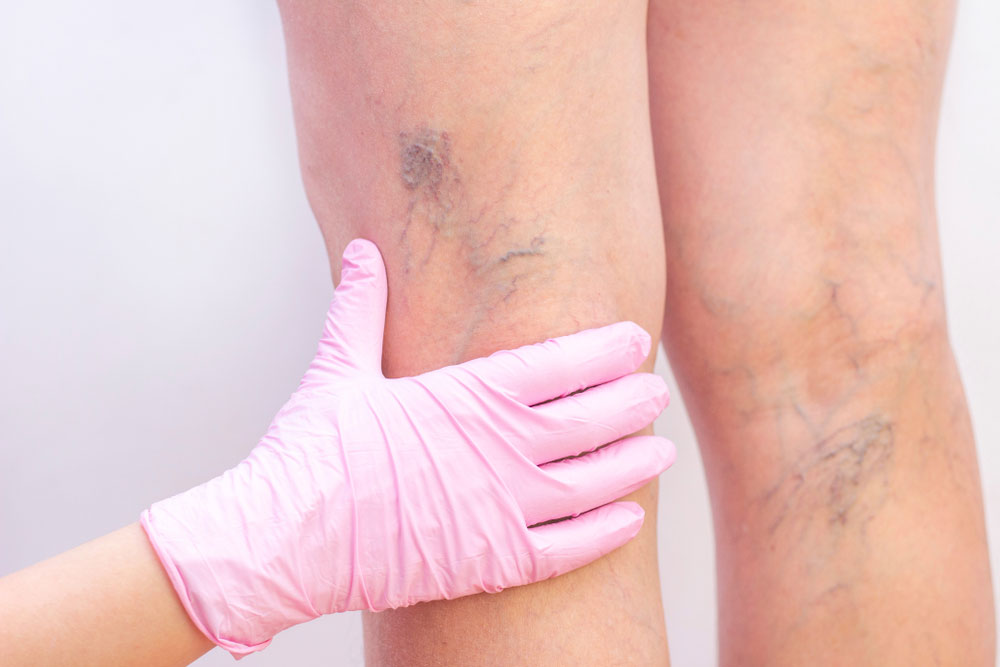 Female legs with varicose veins