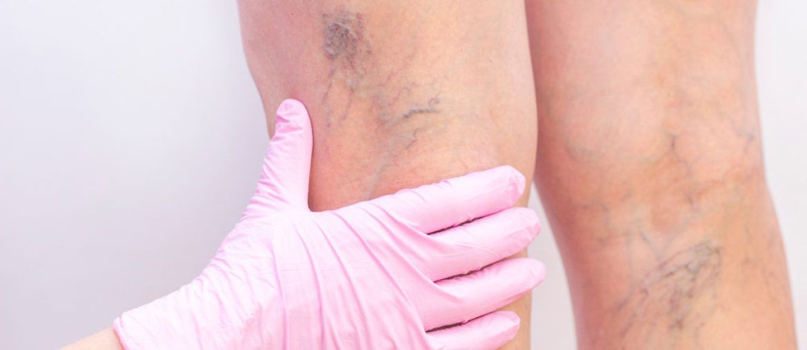 Female legs with varicose veins