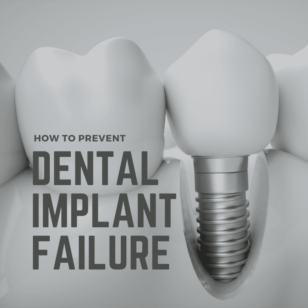 How to Prevent Dental Implant Failure