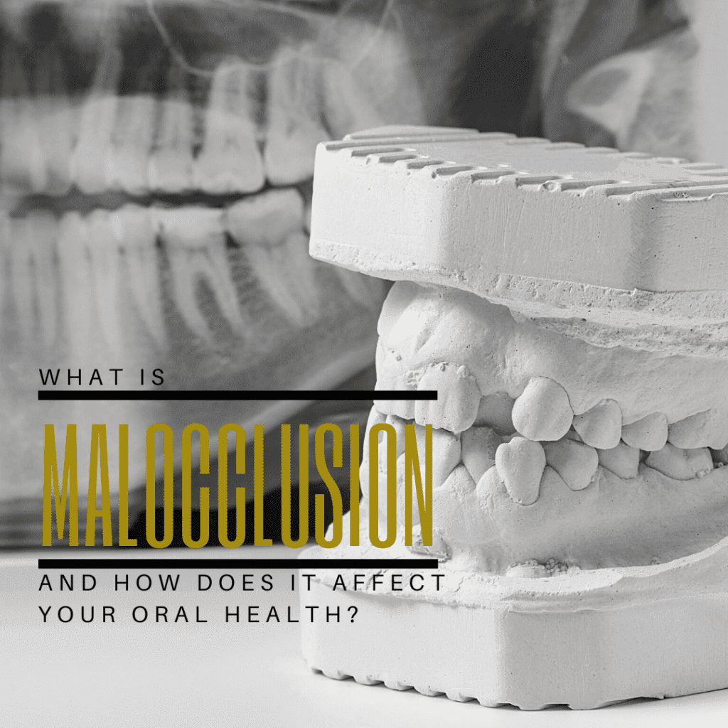 What is Malocclusion and How Does it Affect Your Oral Health