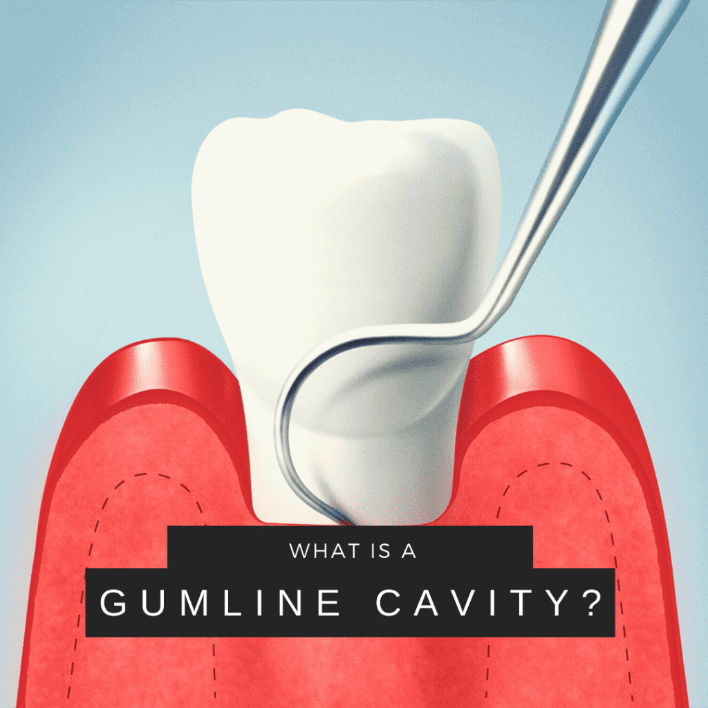 What is a Gum Line Cavity