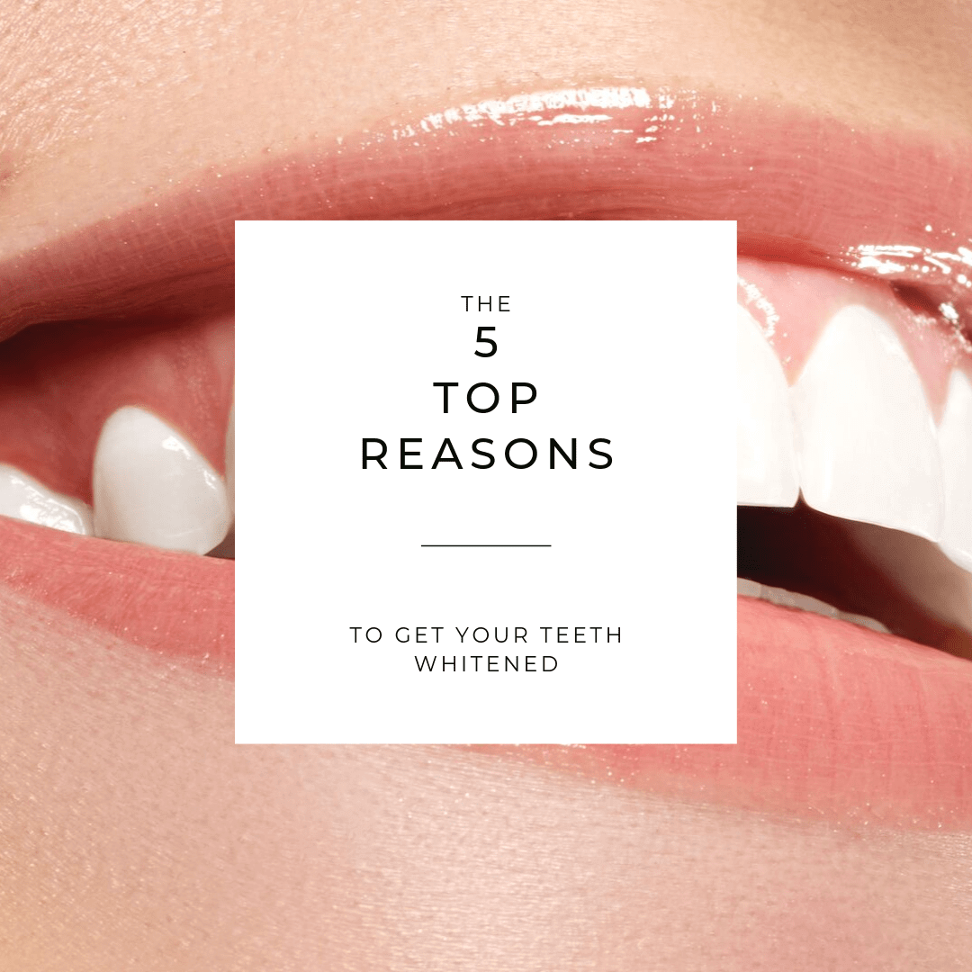The Top 5 Reasons to Get Your Teeth Whitened