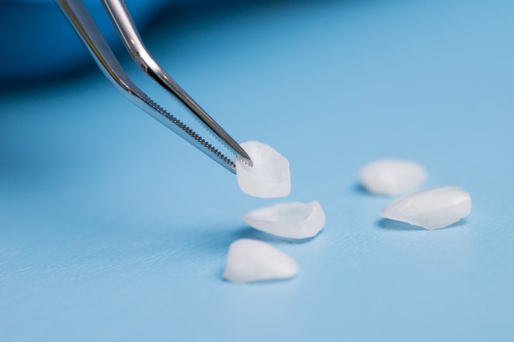 The dentist holds a veneer with tweezers