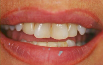 Dental Patient Before Treatment