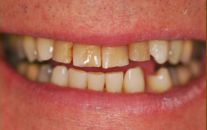 Dental Patient Before Treatment