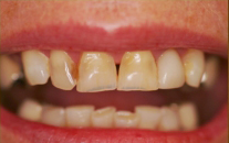 Dental Patient Before Treatment