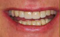 Dental Patient After Treatment