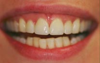 Dental Patient After Treatment