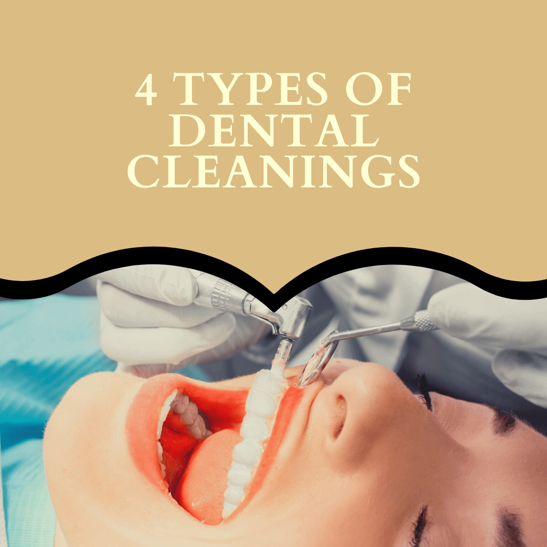 4 Types of Dental Cleanings