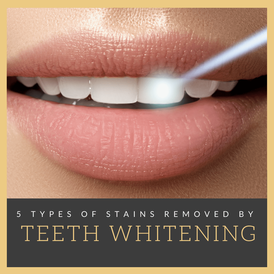 Types of Stains Removed by Teeth Whitening