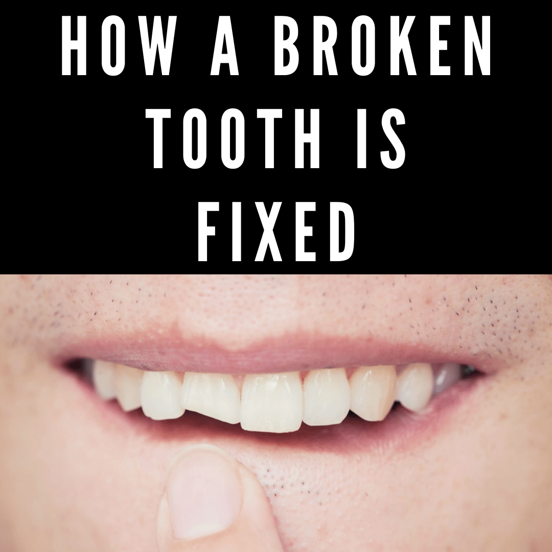 How a Broken Tooth is Fixed
