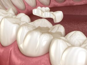 The Ins and Outs of Dental Inlays and Onlays