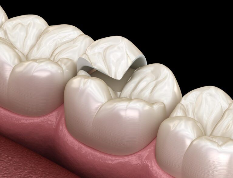The Ins and Outs of Dental Inlays and Onlays