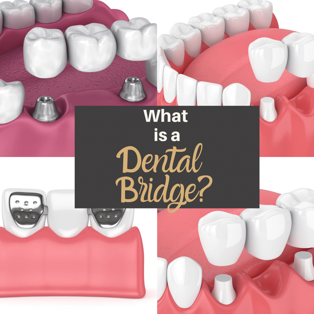 What is a Dental Bridge?